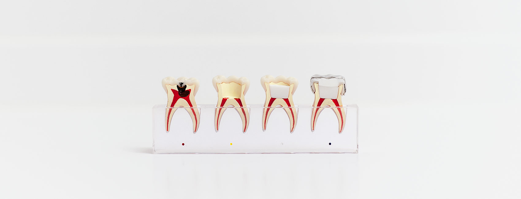 Zahnfüllung bei der Zahnfee Kinderzahnärztin in Köln